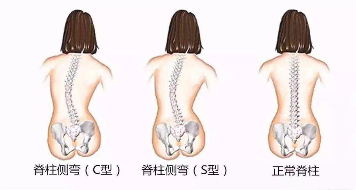 青少年特發(fā)性脊柱側(cè)凸重要致病機(jī)制被鎖定